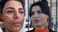 Antalya’da yüz yakan lazer uygulamasına şaşırtan ceza